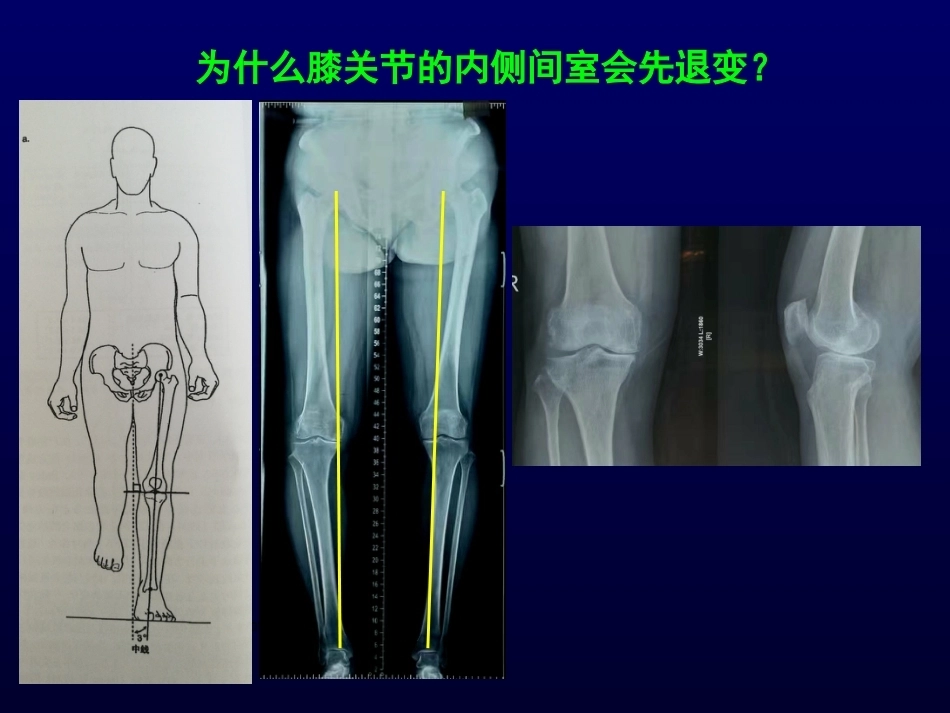 单髁置换治 疗膝关节OA的_第10页