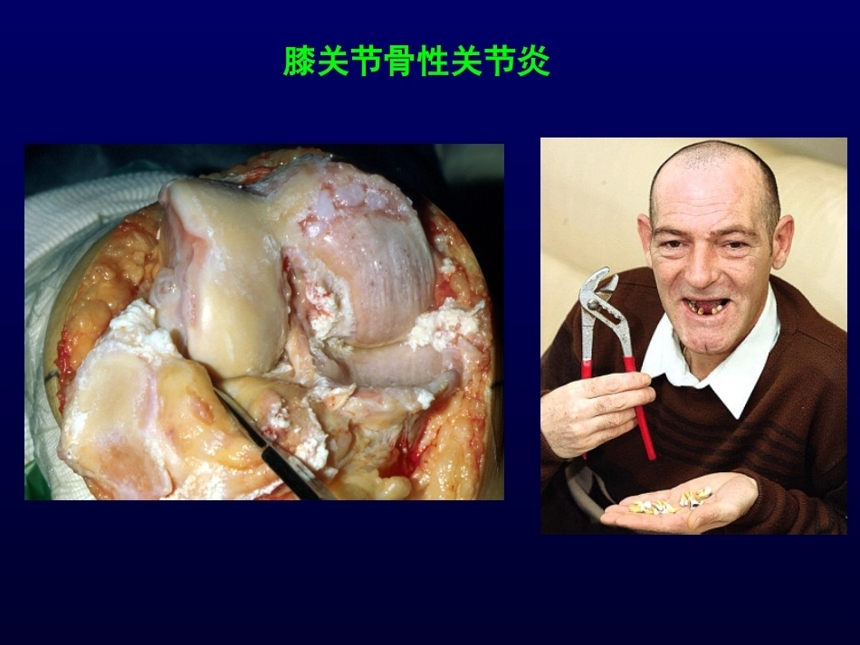 单髁置换治 疗膝关节OA的_第13页