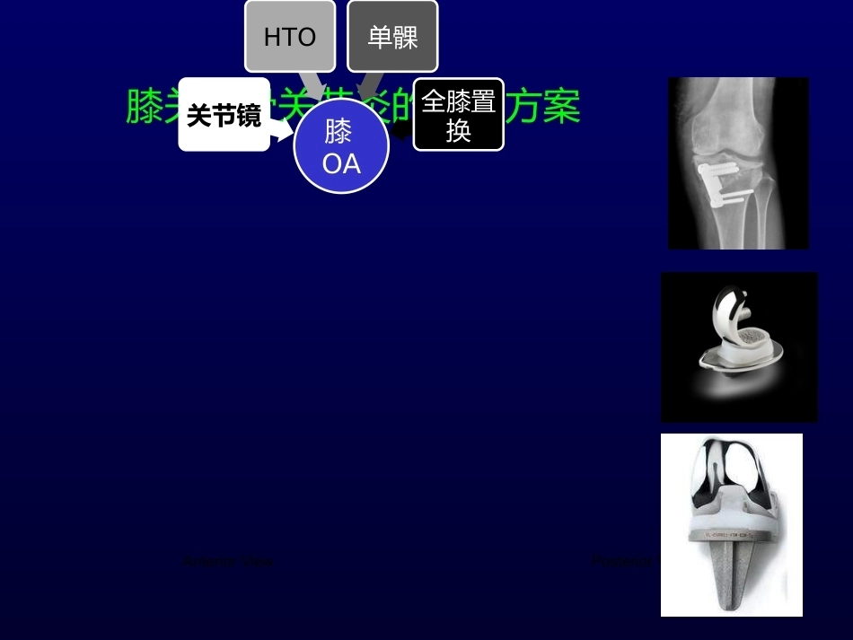 单髁置换治 疗膝关节OA的_第14页