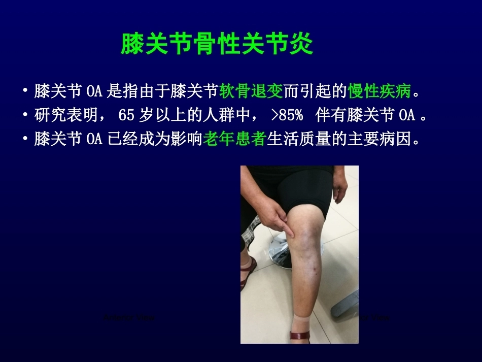 单髁置换治 疗膝关节OA的_第2页