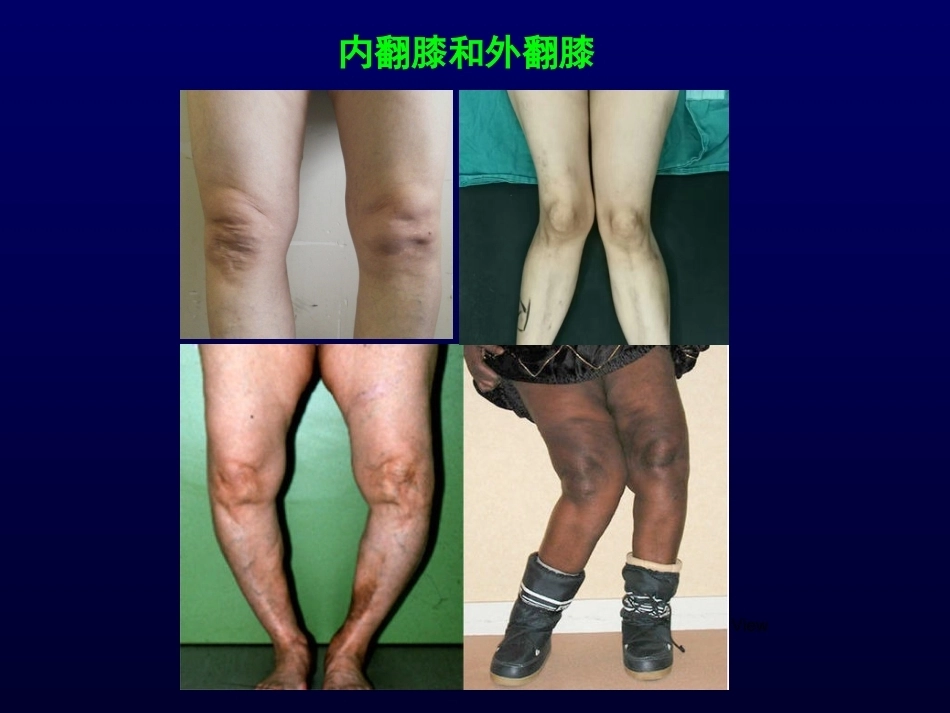 单髁置换治 疗膝关节OA的_第3页