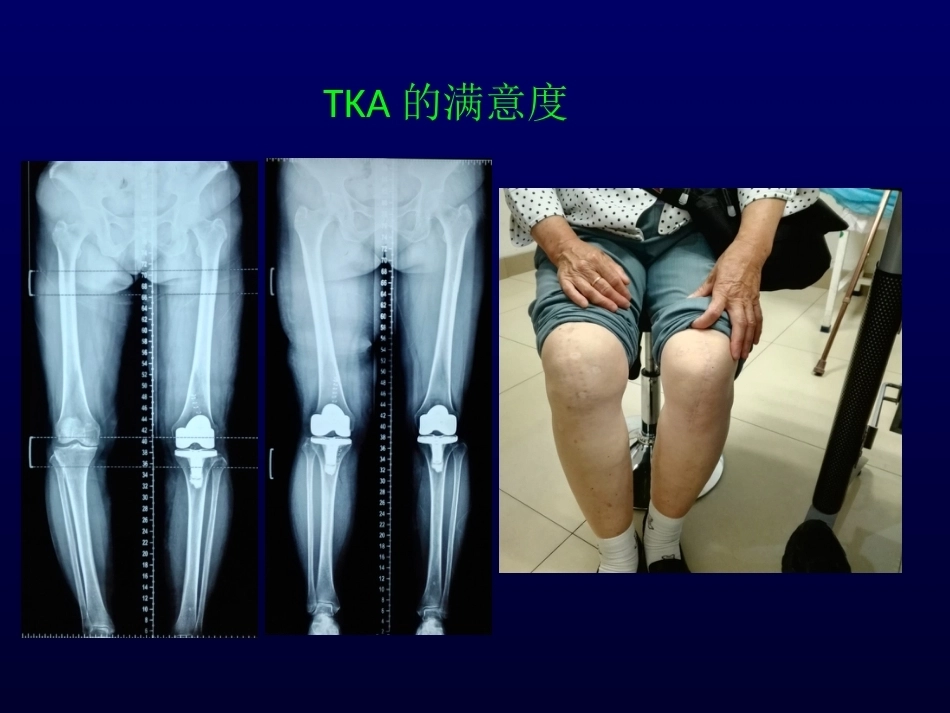 单髁置换治 疗膝关节OA的_第5页