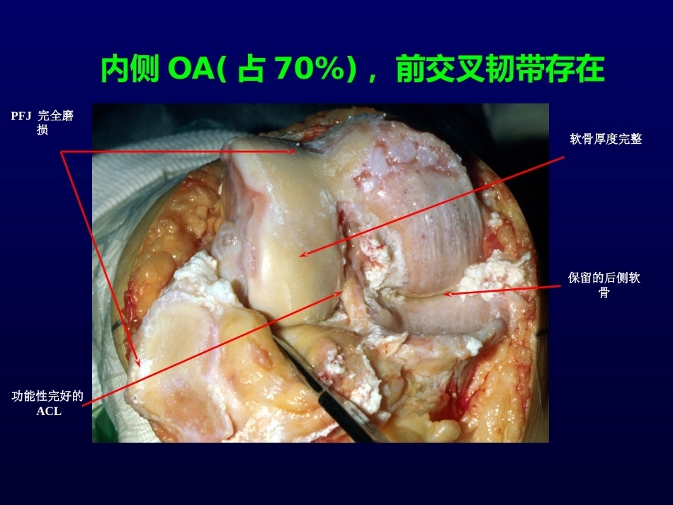 单髁置换治 疗膝关节OA的_第6页
