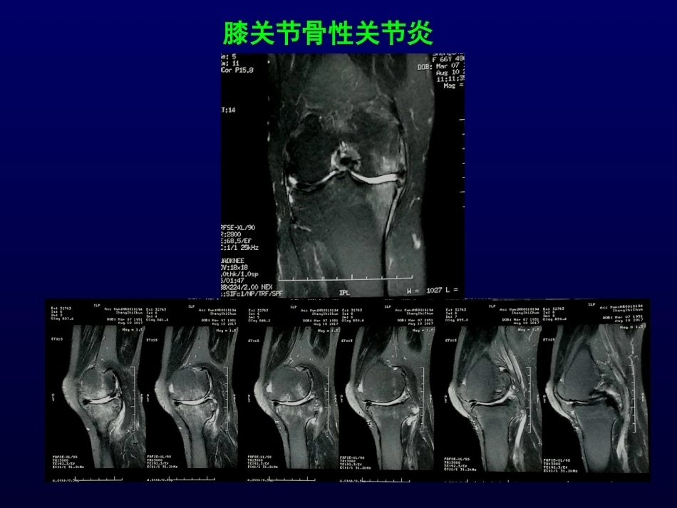 单髁置换治 疗膝关节OA的_第9页