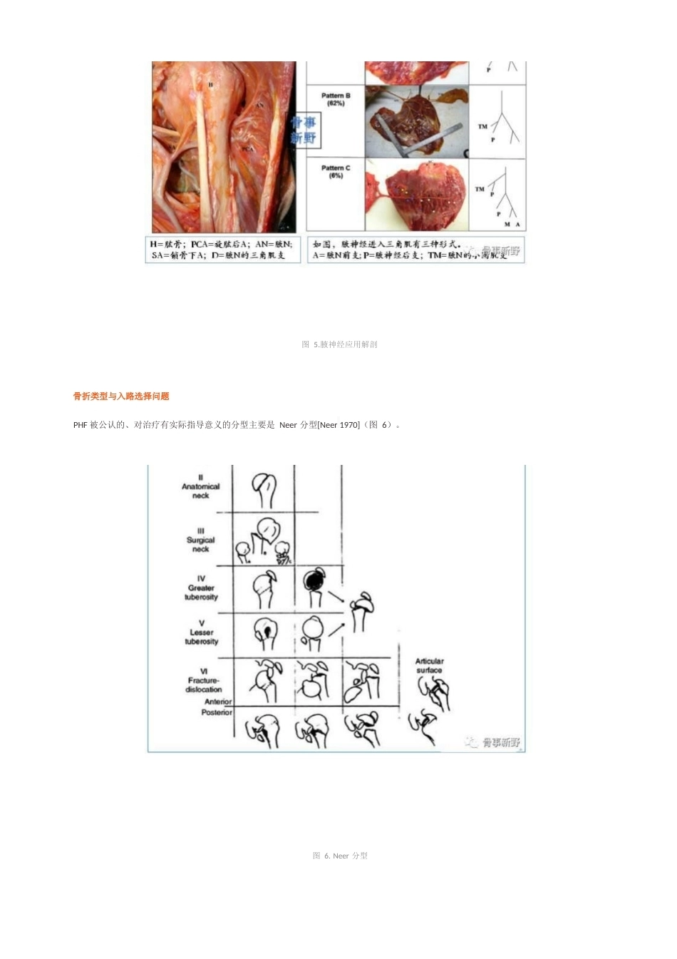 肱骨近端骨折的微创入 路ORIF手术技巧_第4页