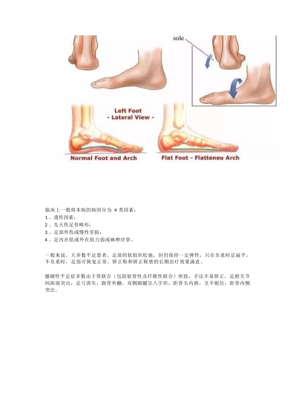 扁平足的 临床诊治技巧_第3页