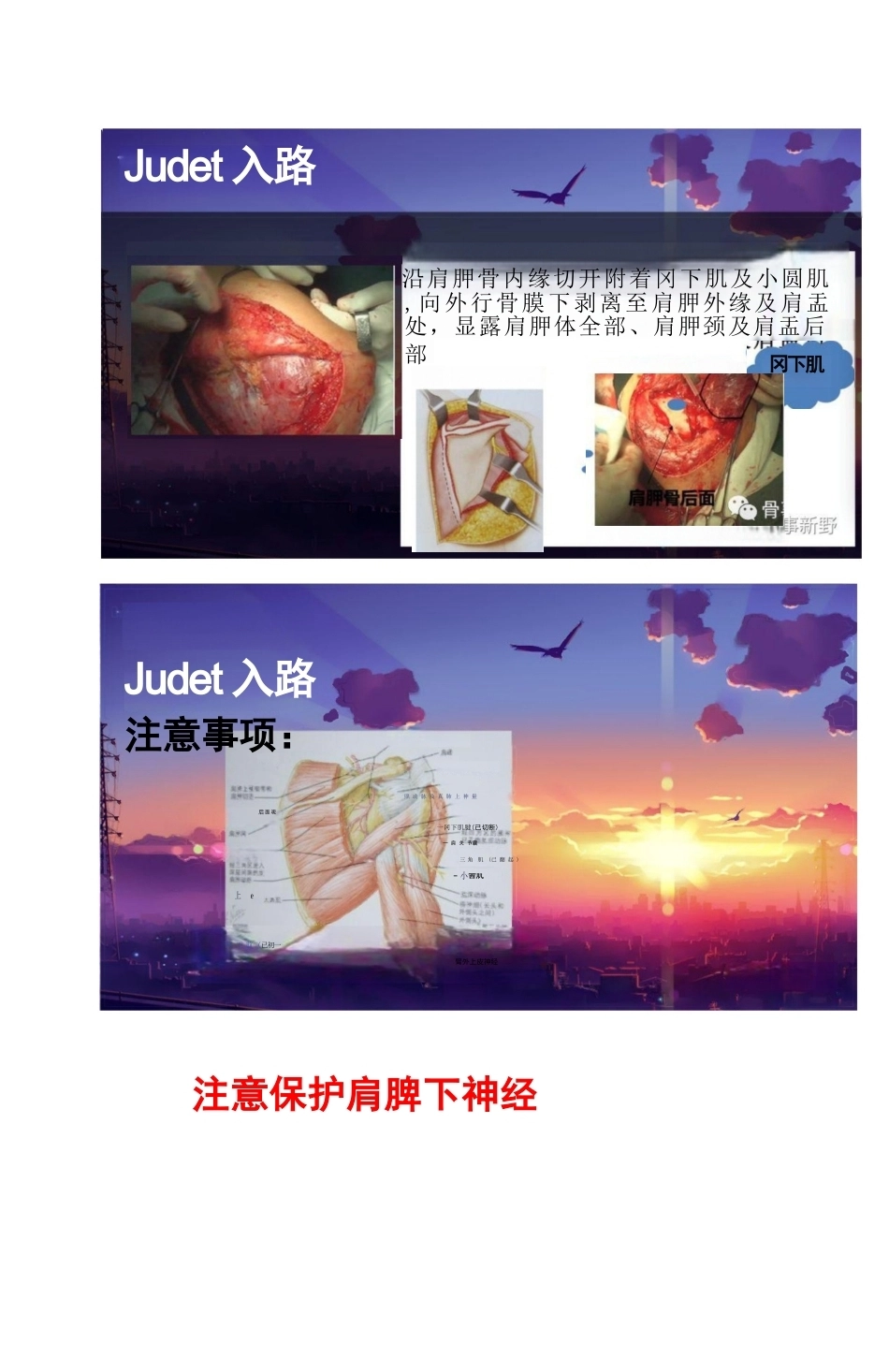 肩胛骨骨折的手术 入路解析_第3页