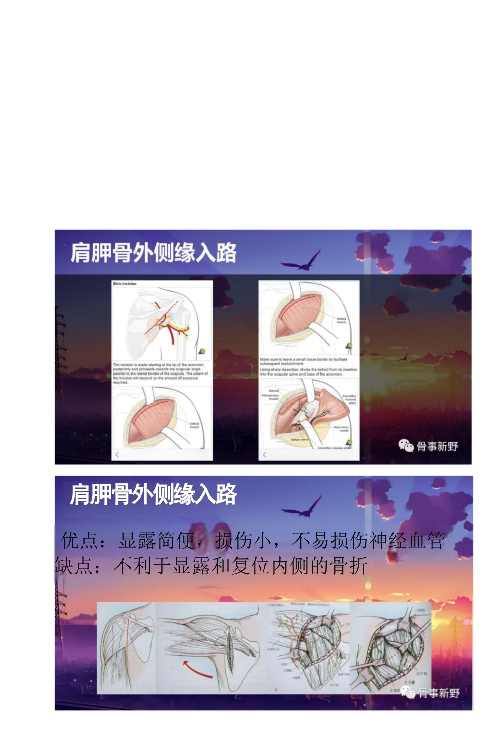 肩胛骨骨折的手术 入路解析_第5页