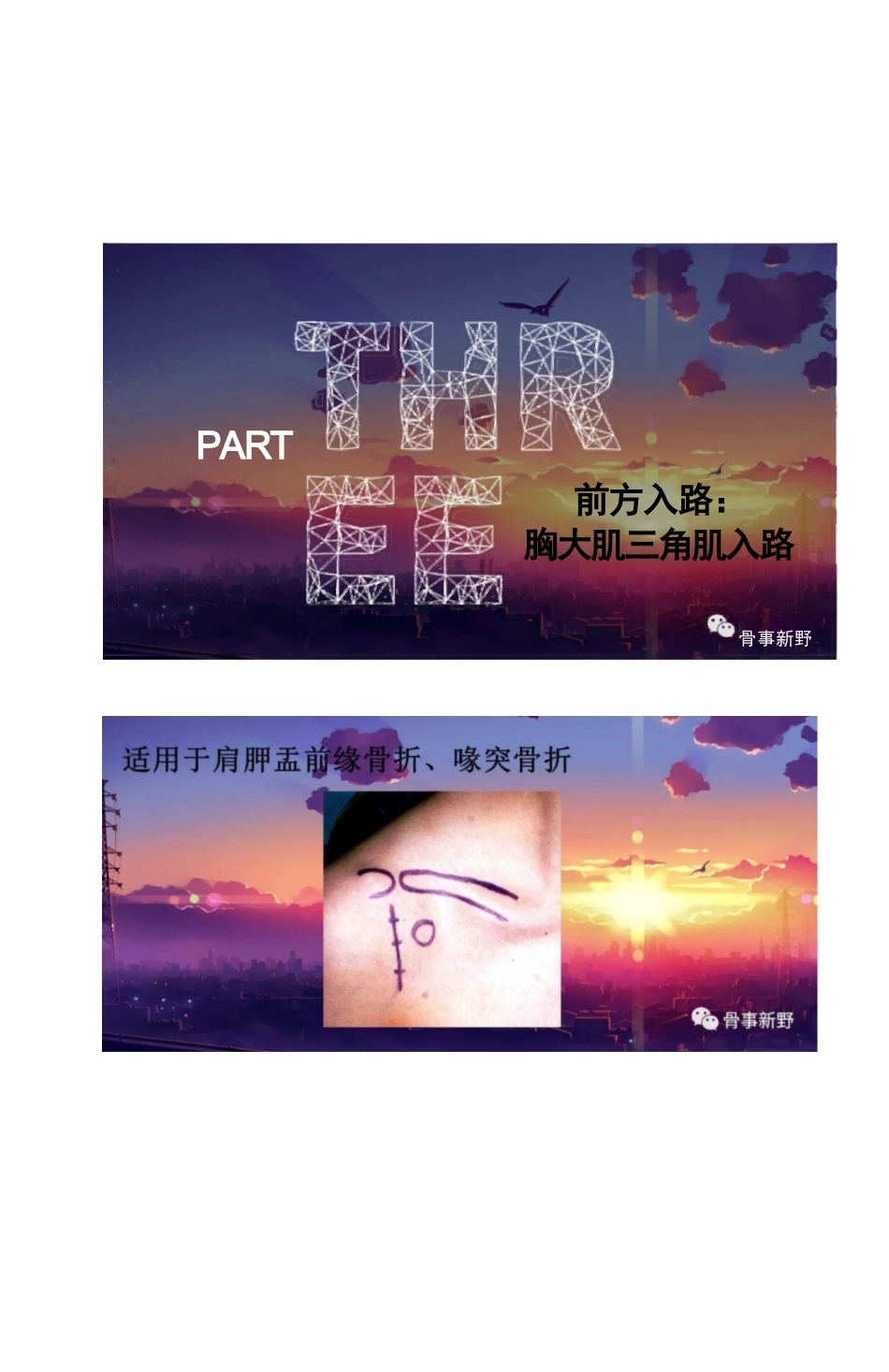 肩胛骨骨折的手术 入路解析_第6页