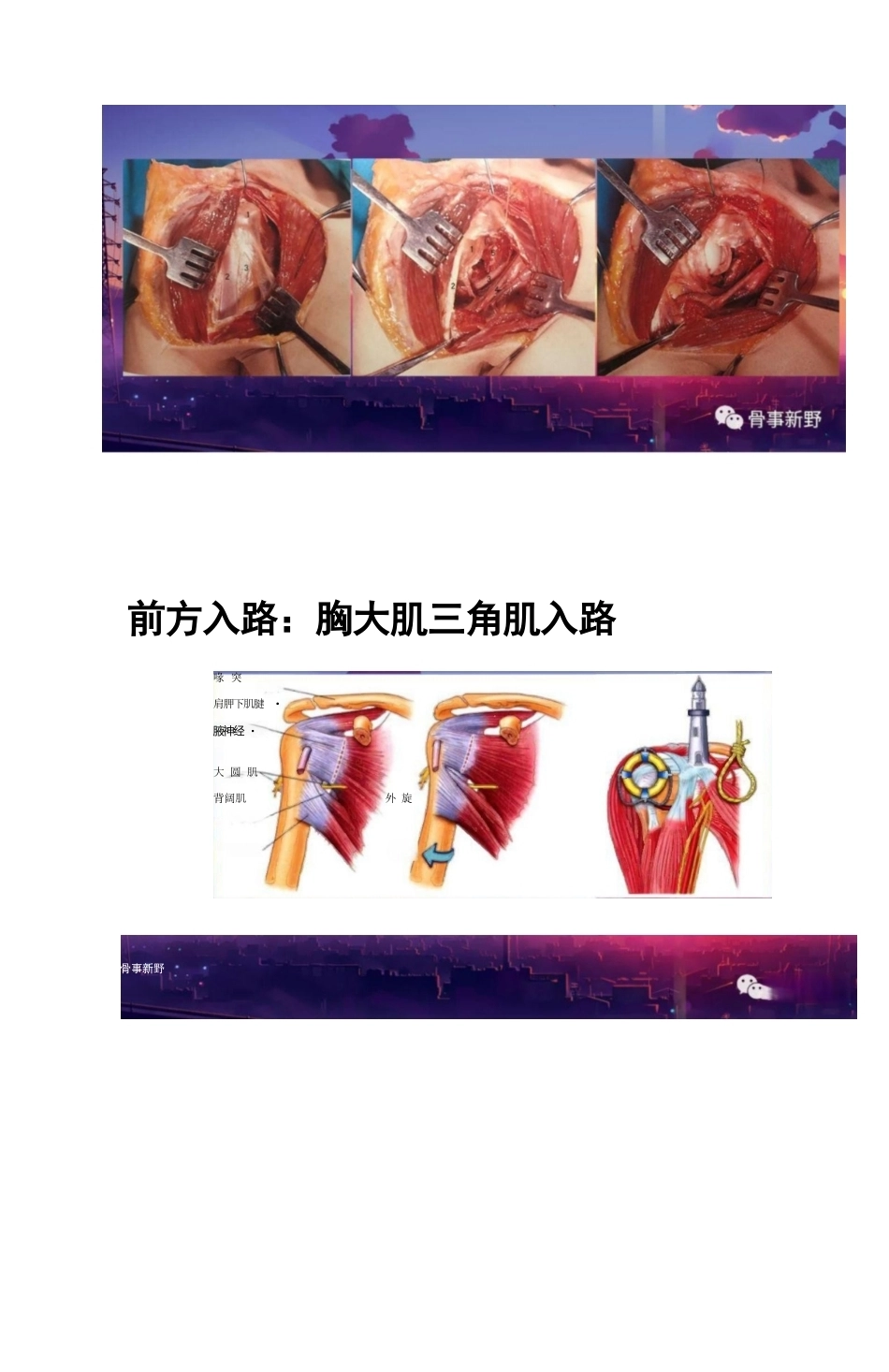 肩胛骨骨折的手术 入路解析_第7页