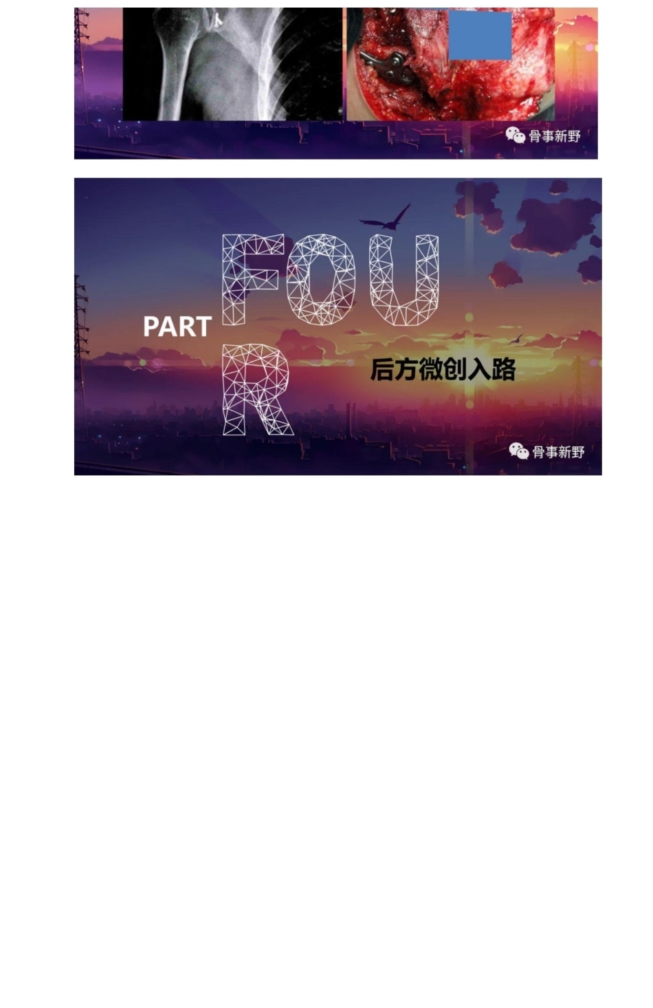 肩胛骨骨折的手术 入路解析_第8页