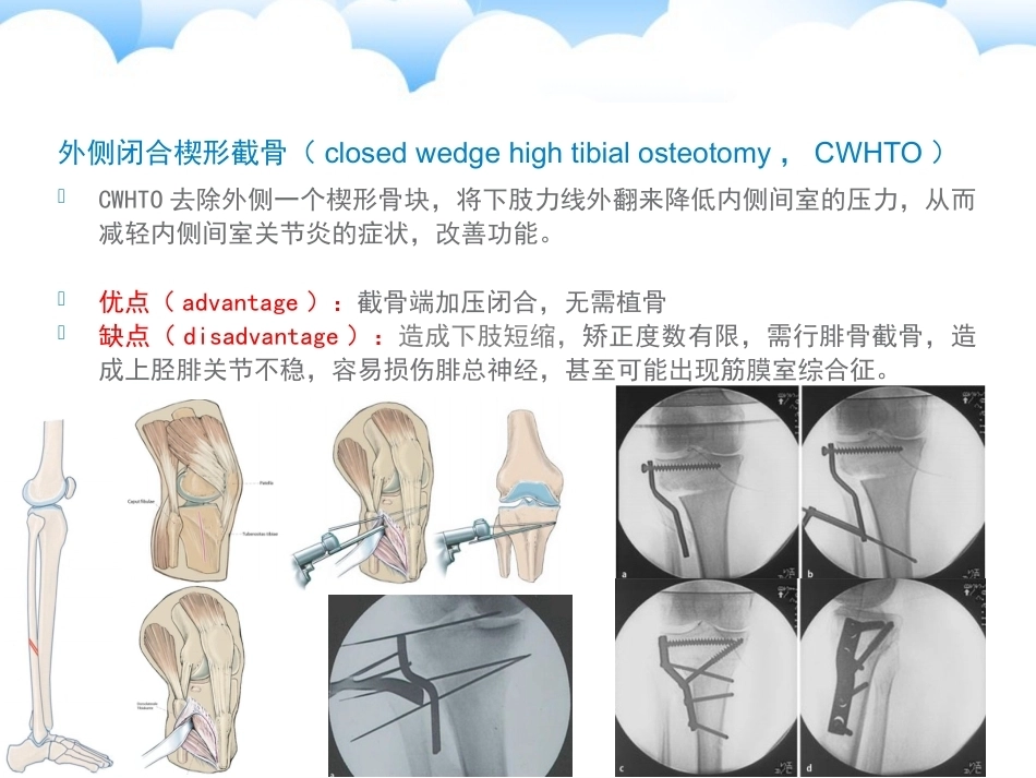 保膝治疗之胫骨高位截骨术_第14页