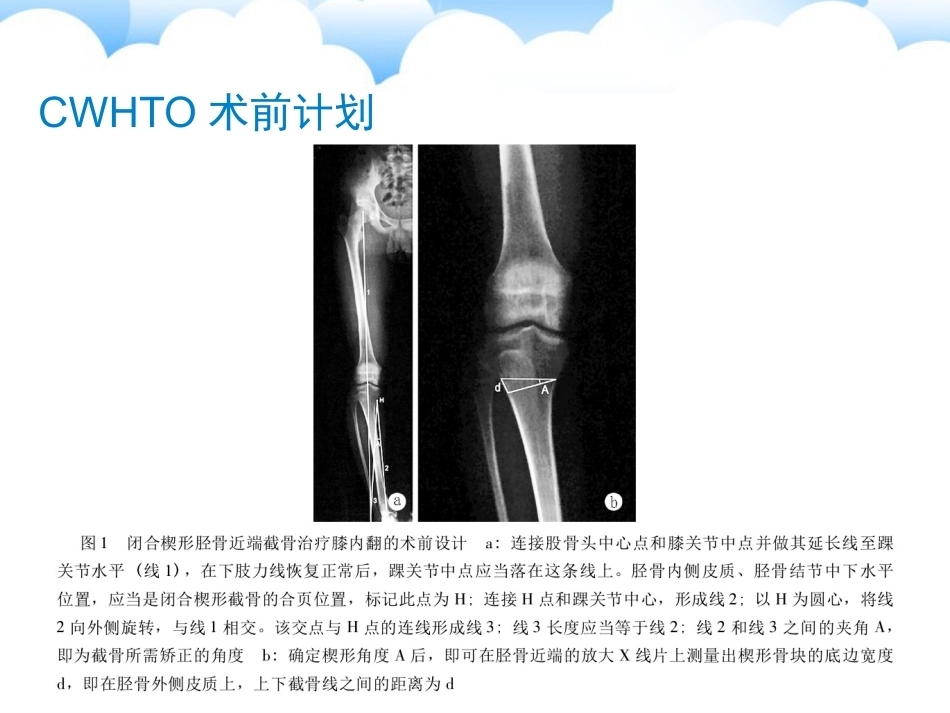 保膝治疗之胫骨高位截骨术_第15页