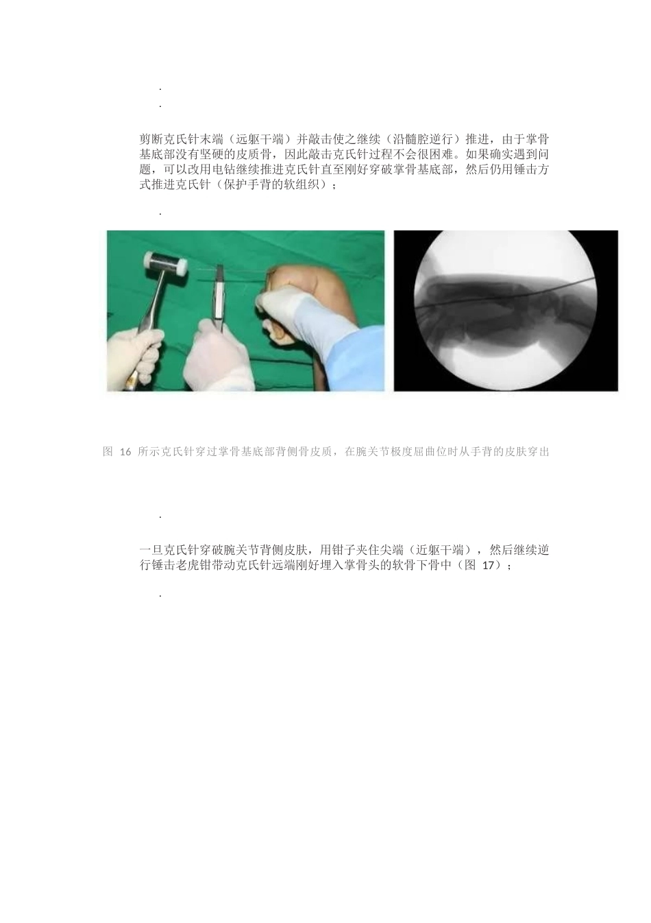 髓内针治疗移位性掌骨颈 骨折技术_第15页
