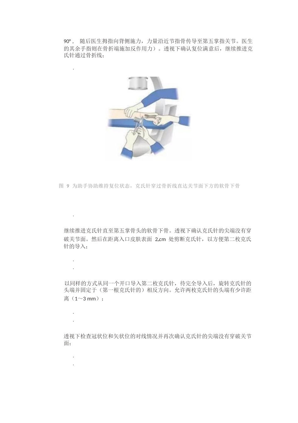 髓内针治疗移位性掌骨颈 骨折技术_第9页