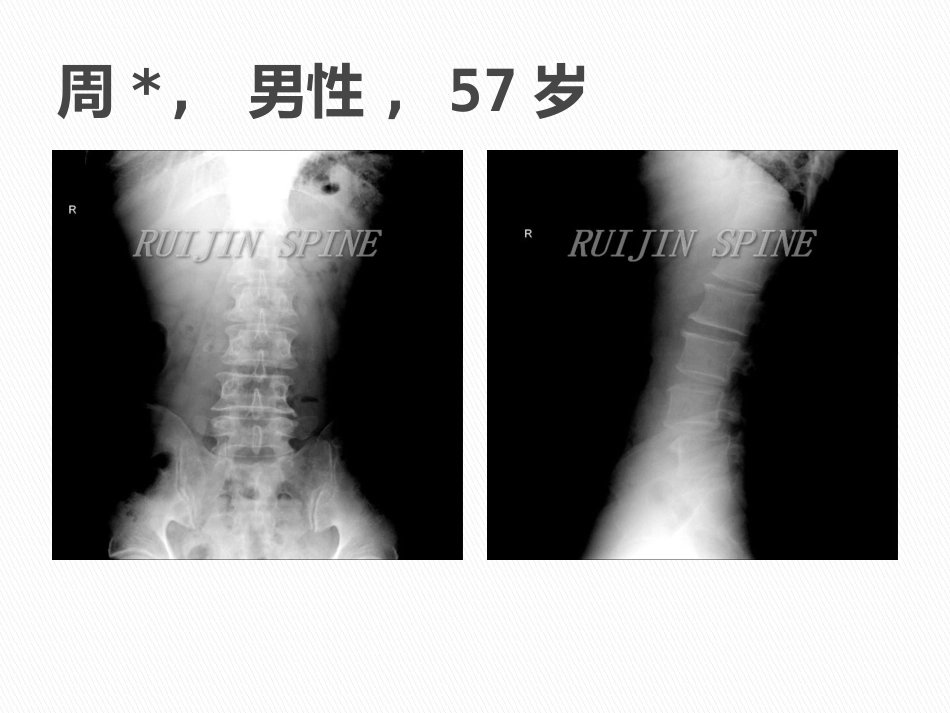 MIS-TLIF治疗腰椎 峡部性滑脱_第10页