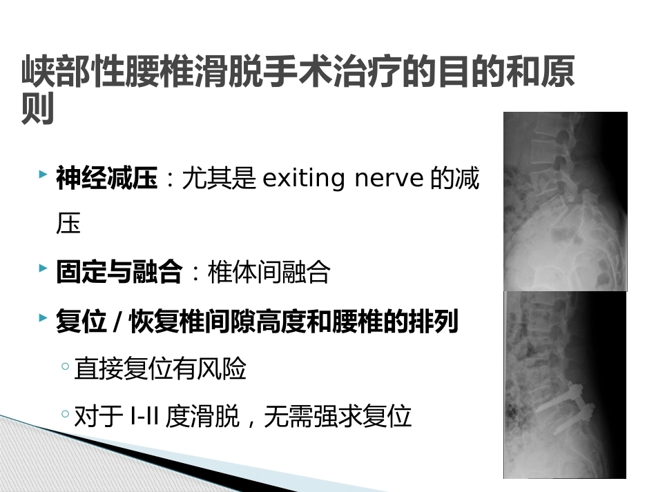 MIS-TLIF治疗腰椎 峡部性滑脱_第4页
