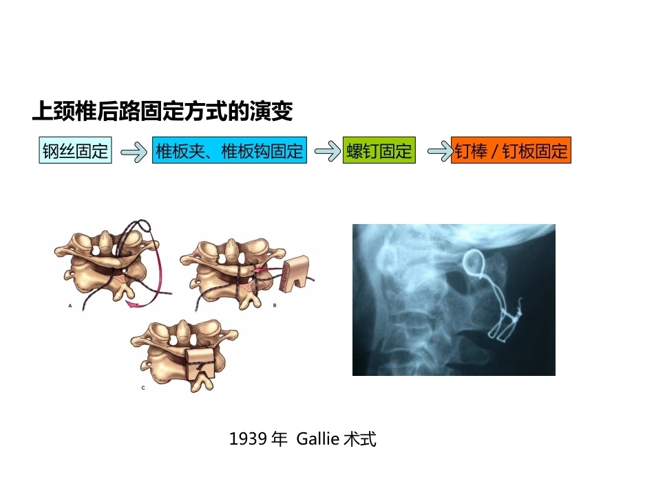 上颈椎后路内固定技术复件_第2页