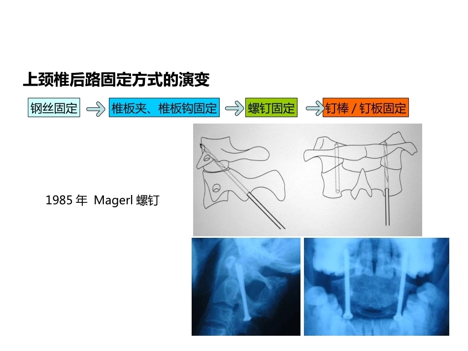 上颈椎后路内固定技术复件_第6页