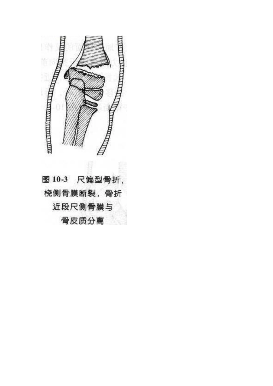 肱骨髁上骨折分型_第3页
