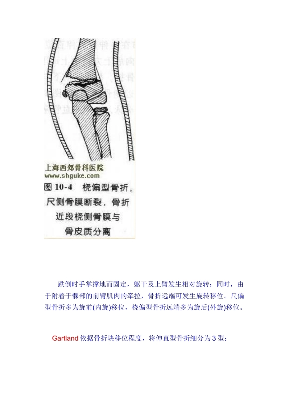 肱骨髁上骨折分型_第4页