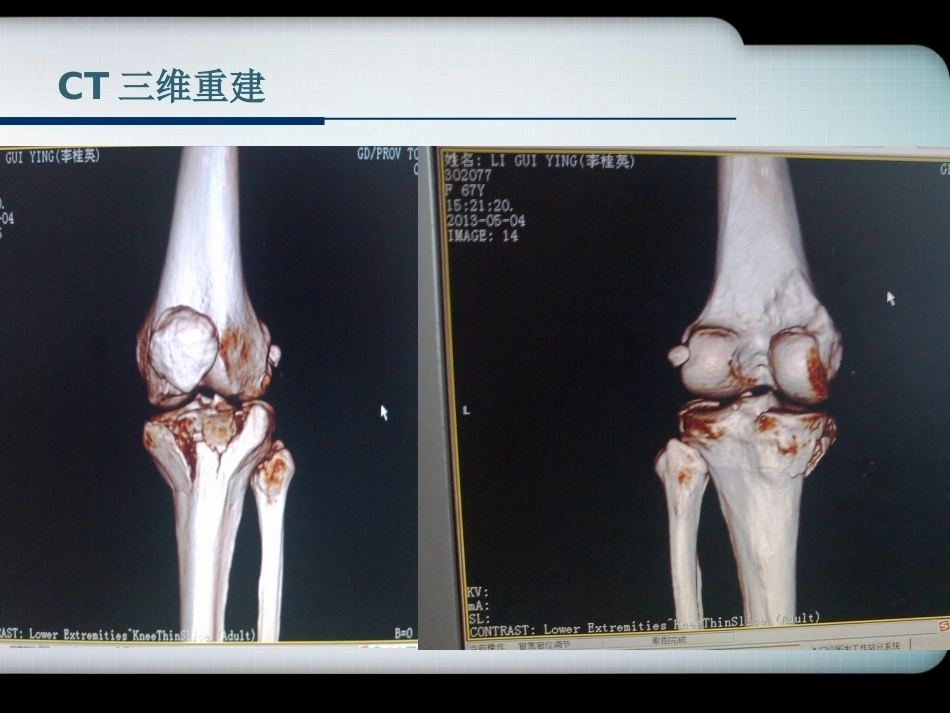 胫骨平台骨折的诊断与分型_第4页