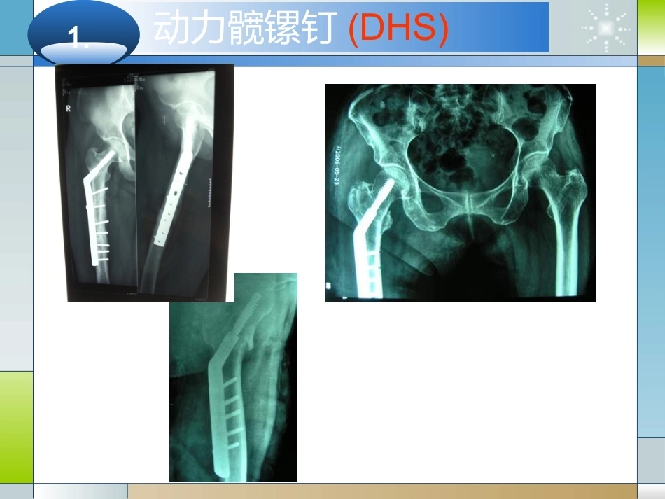 股骨粗隆间骨折的临床分型和治疗_第13页