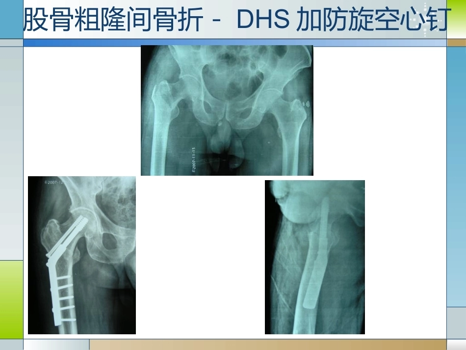 股骨粗隆间骨折的临床分型和治疗_第14页