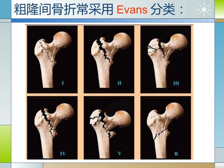 股骨粗隆间骨折的临床分型和治疗_第6页