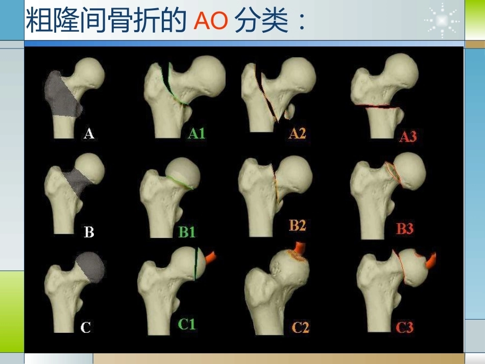 股骨粗隆间骨折的临床分型和治疗_第7页