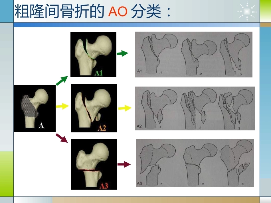 股骨粗隆间骨折的临床分型和治疗_第8页