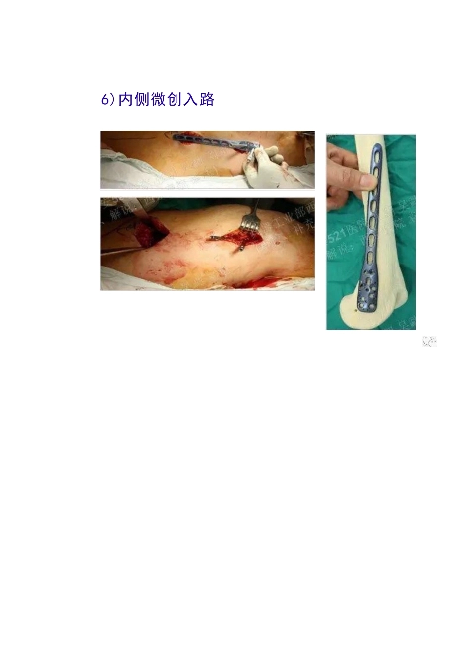 股骨远端骨折的手 术治疗技巧_第15页