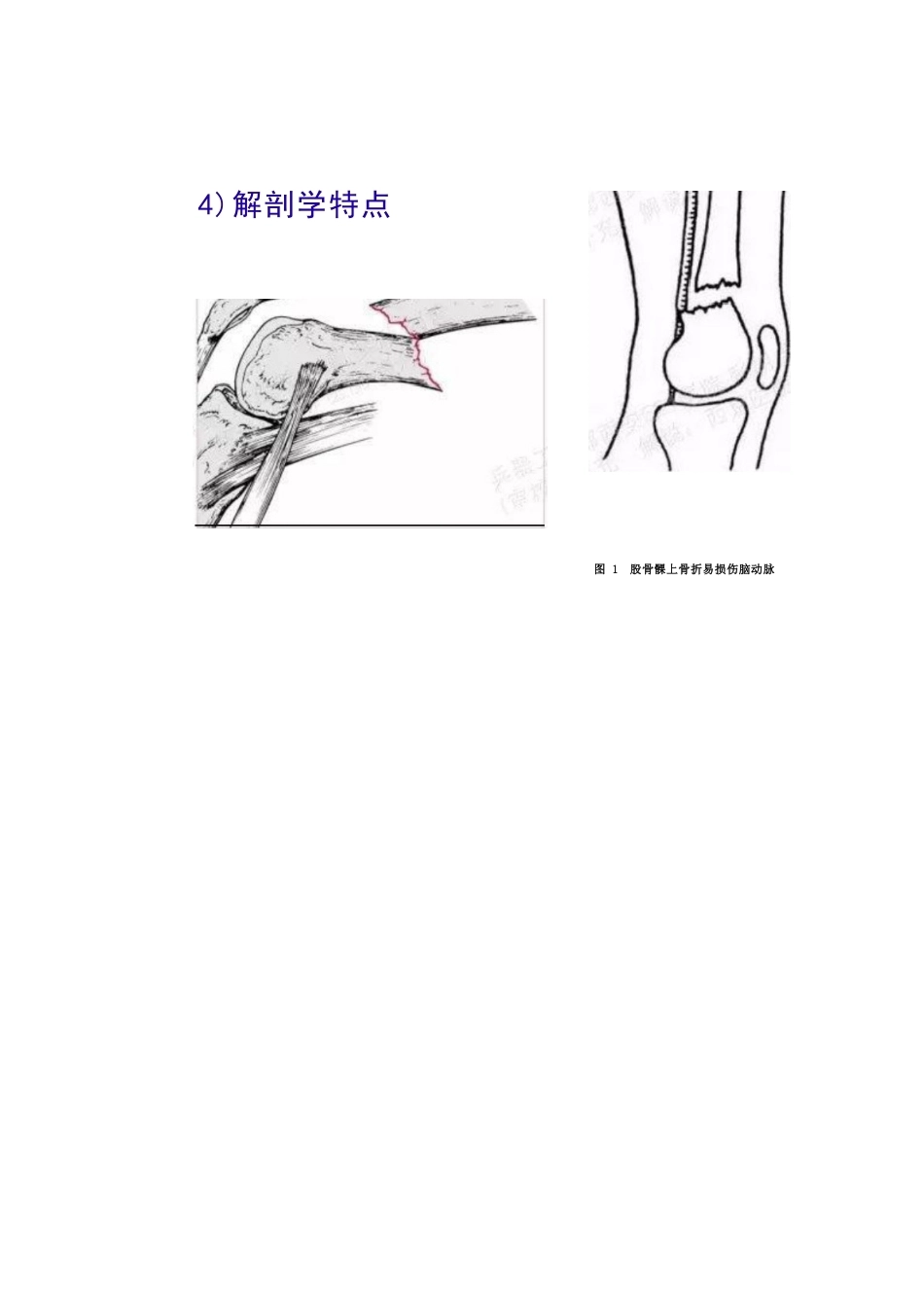 股骨远端骨折的手 术治疗技巧_第8页