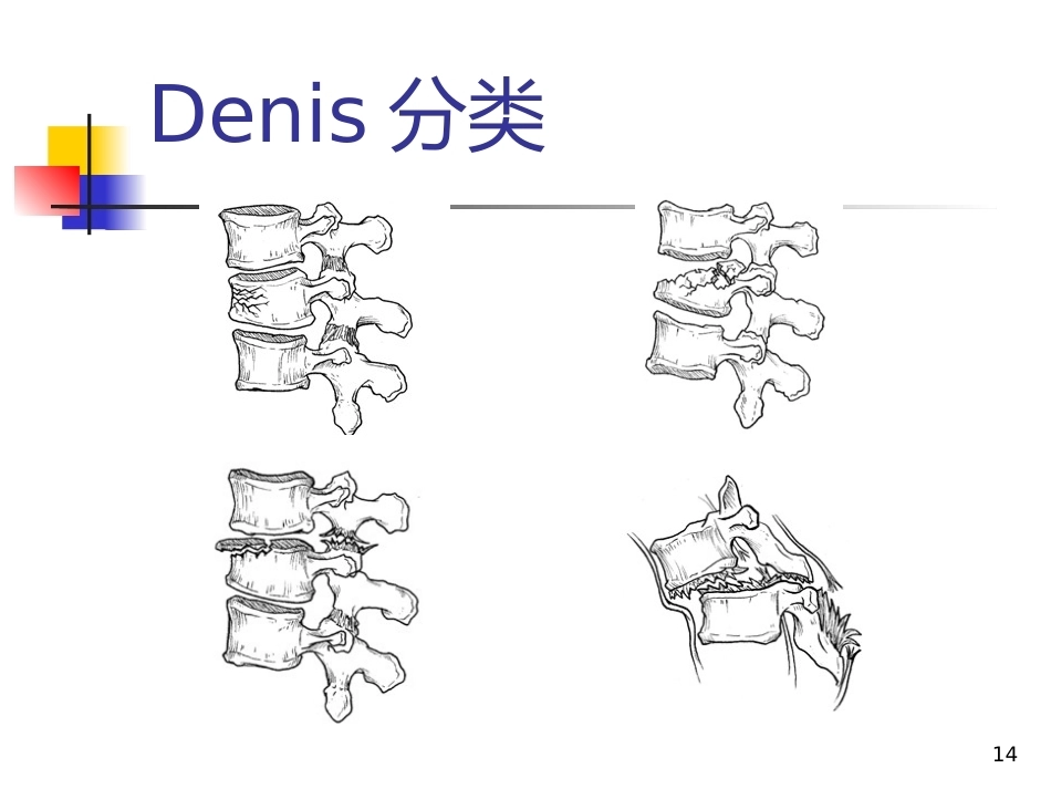 胸腰椎爆裂性骨折的 治疗_第14页