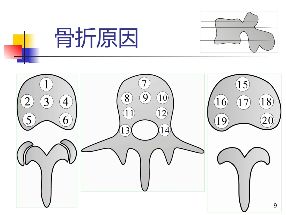 胸腰椎爆裂性骨折的 治疗_第9页