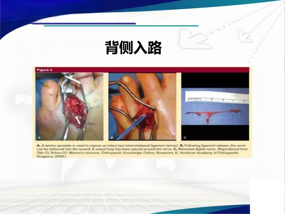 跖间神 经瘤_第14页