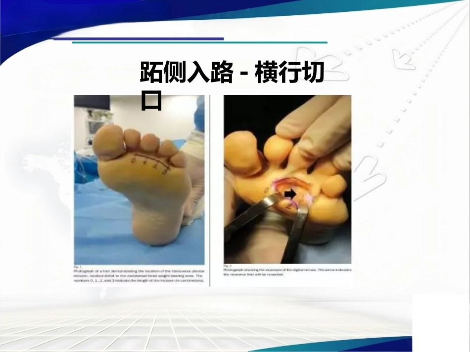 跖间神 经瘤_第15页