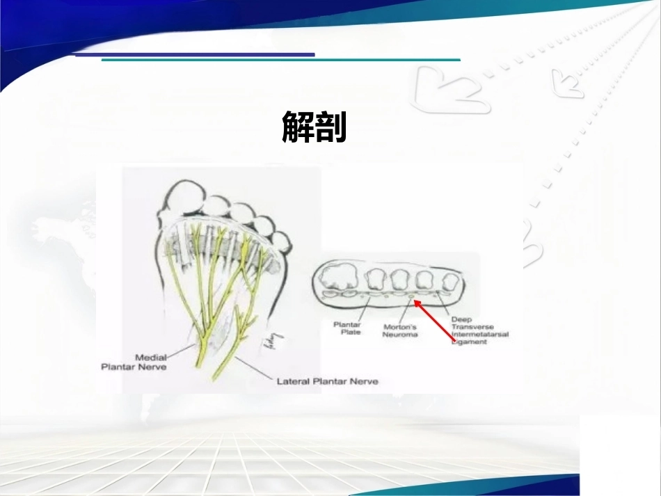 跖间神 经瘤_第6页