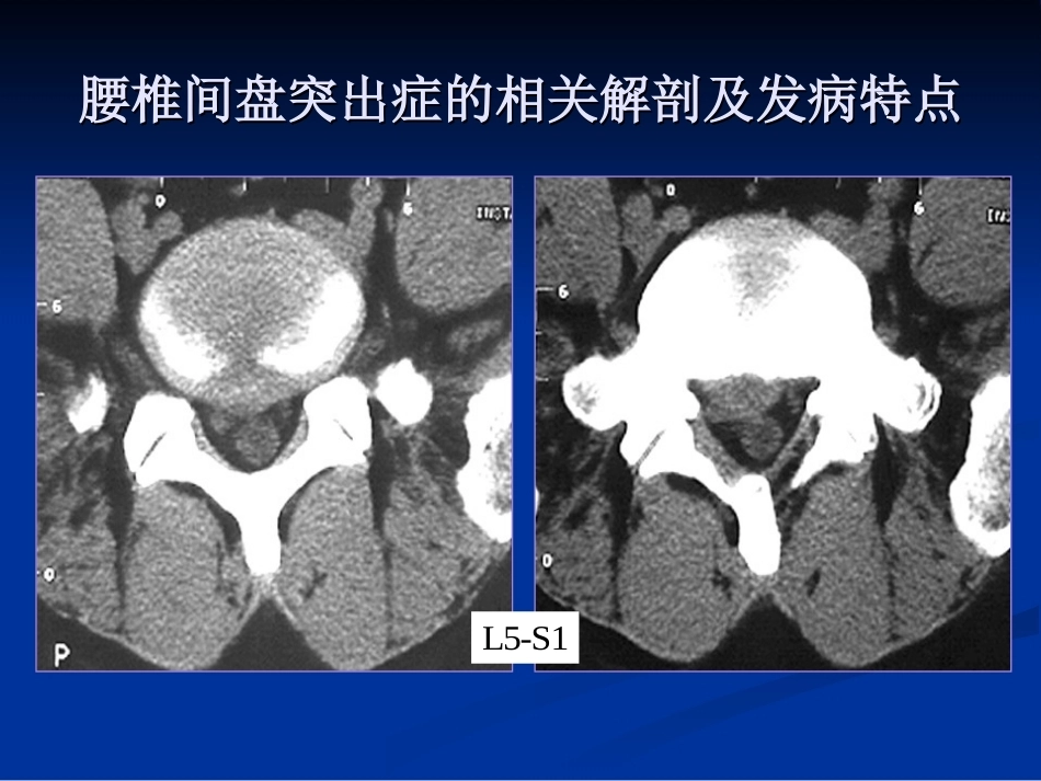 腰椎间盘突出症的诊断、鉴别诊断与分型_第12页