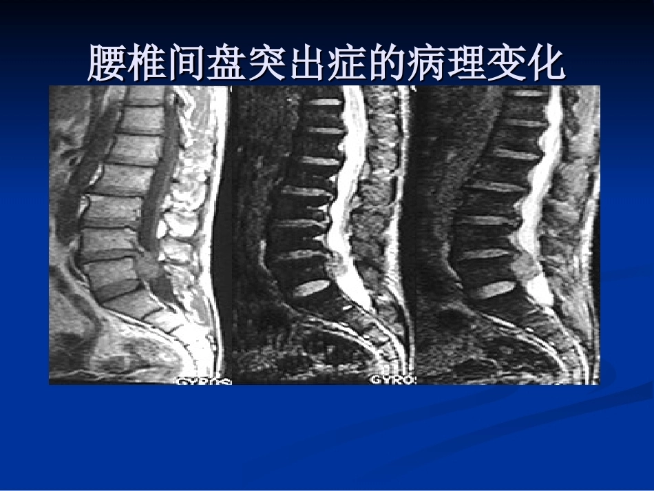 腰椎间盘突出症的诊断、鉴别诊断与分型_第15页