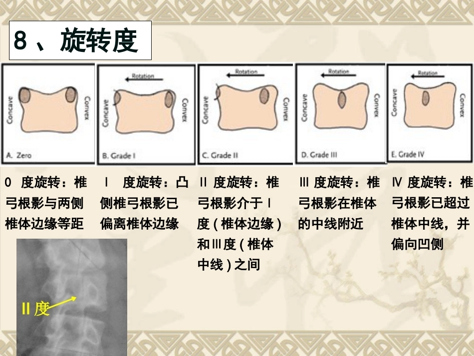 脊柱侧弯的治疗 与对策_第12页