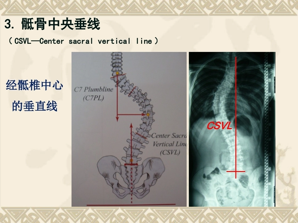脊柱侧弯的治疗 与对策_第6页