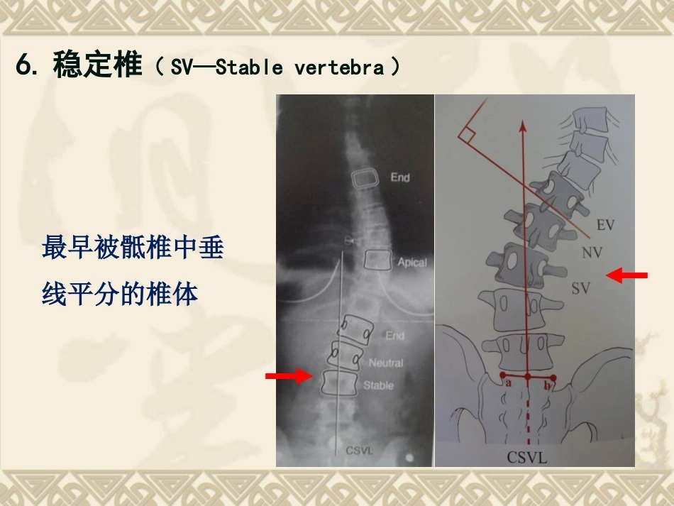 脊柱侧弯的治疗 与对策_第9页