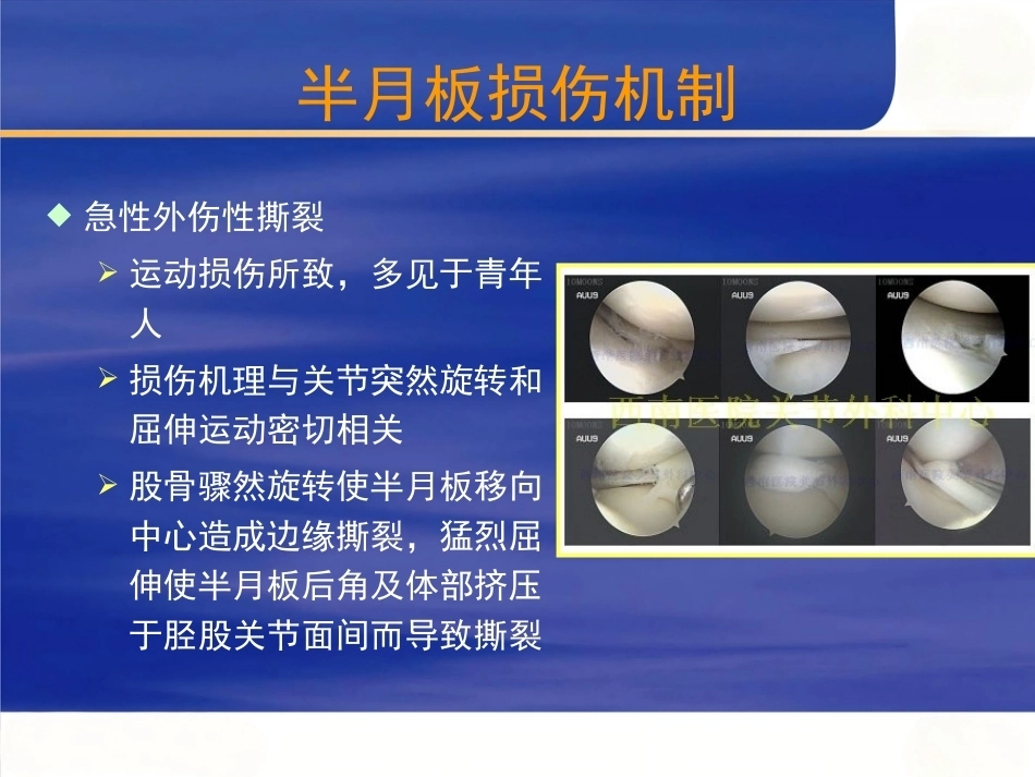 膝关节 半月板损伤的诊断_第3页