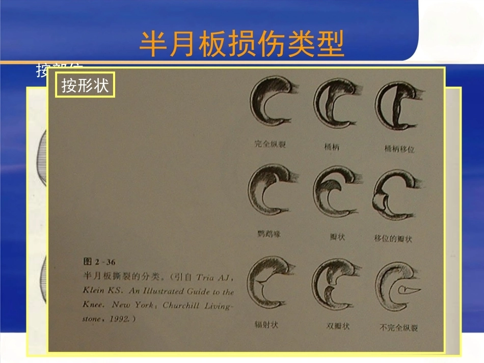 膝关节 半月板损伤的诊断_第7页