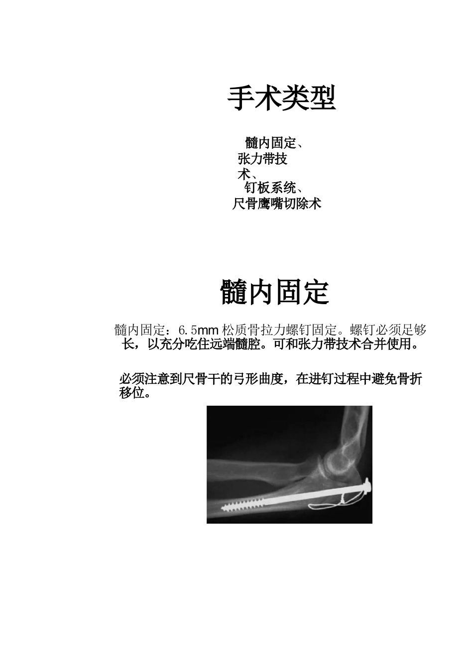 尺骨鹰嘴骨折的手术分型_第12页