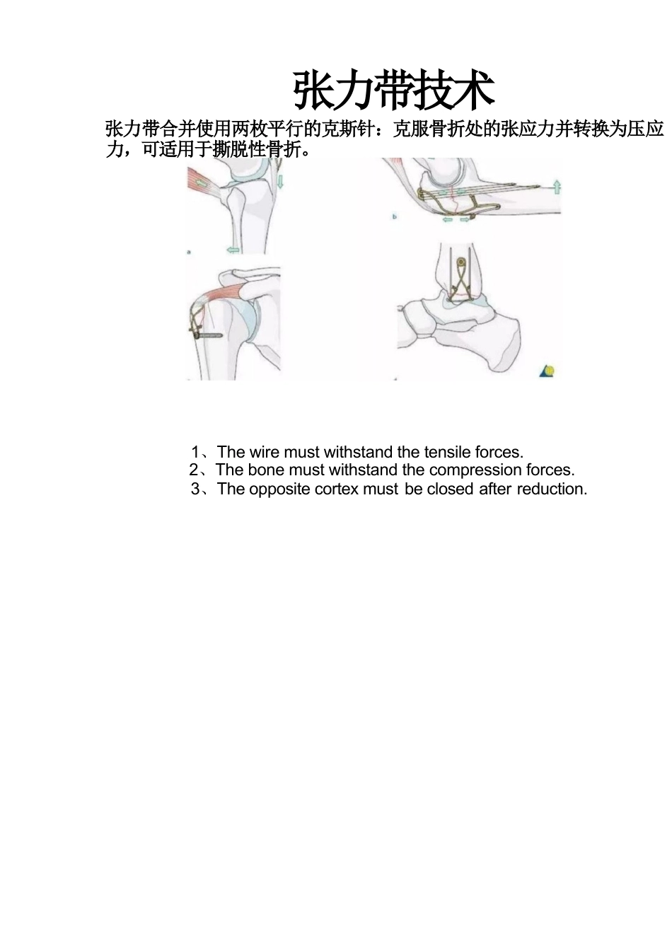 尺骨鹰嘴骨折的手术分型_第13页