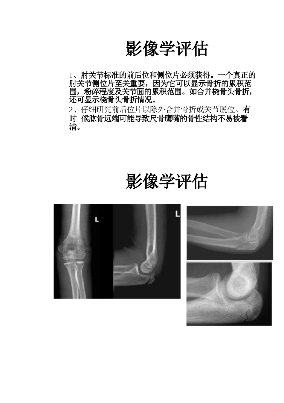 尺骨鹰嘴骨折的手术分型_第6页