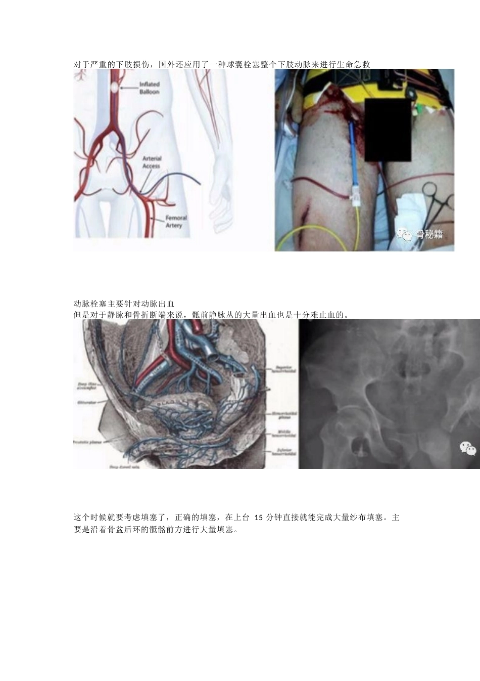 骨盆骨折的急 救治疗_第13页