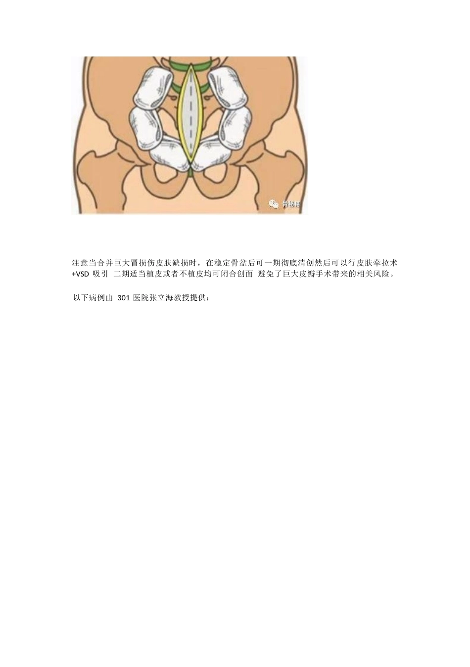 骨盆骨折的急 救治疗_第14页
